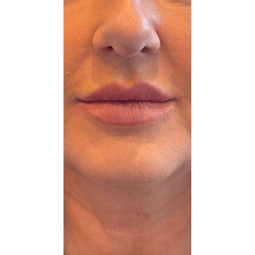 Dr Sknn Lip Fillers After