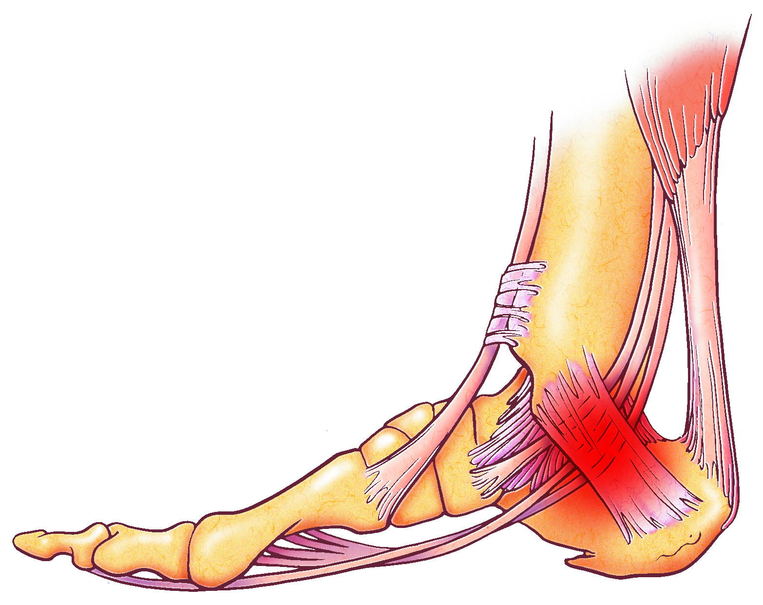 MODERATE & SEVERE SPRAINS ILLUSTRATION