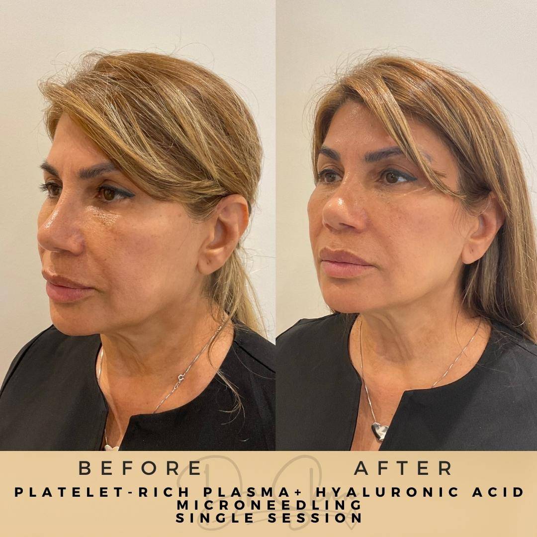 PRP Microneedling - Dr Sknn before and after
