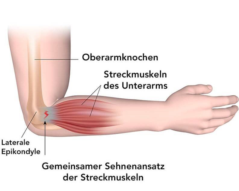 Abbildung Fersenbein, dem Fersensporn  und der Ertzündung Plantarfaszits