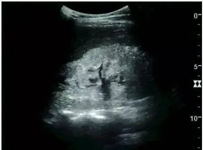 Nephrotic syndrome: echogenic demarcation of renal cortex and medulla scanned by EagleView portable ultrasound.
