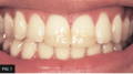 smile showing traumatized anterior teeth