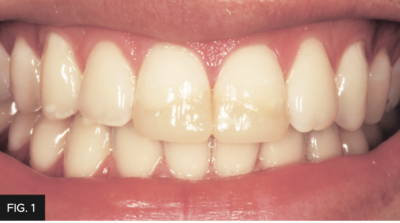 smile showing traumatized anterior teeth