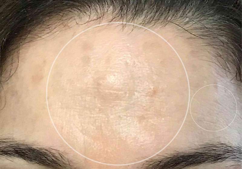 collagen-before-and-after-pictures-wrinkles-forehead-between-eyebrows