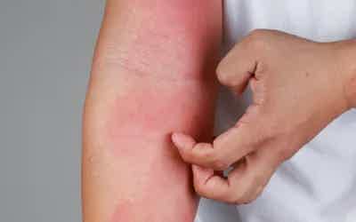 ECZEMA: WHAT YOU NEED TO KNOW