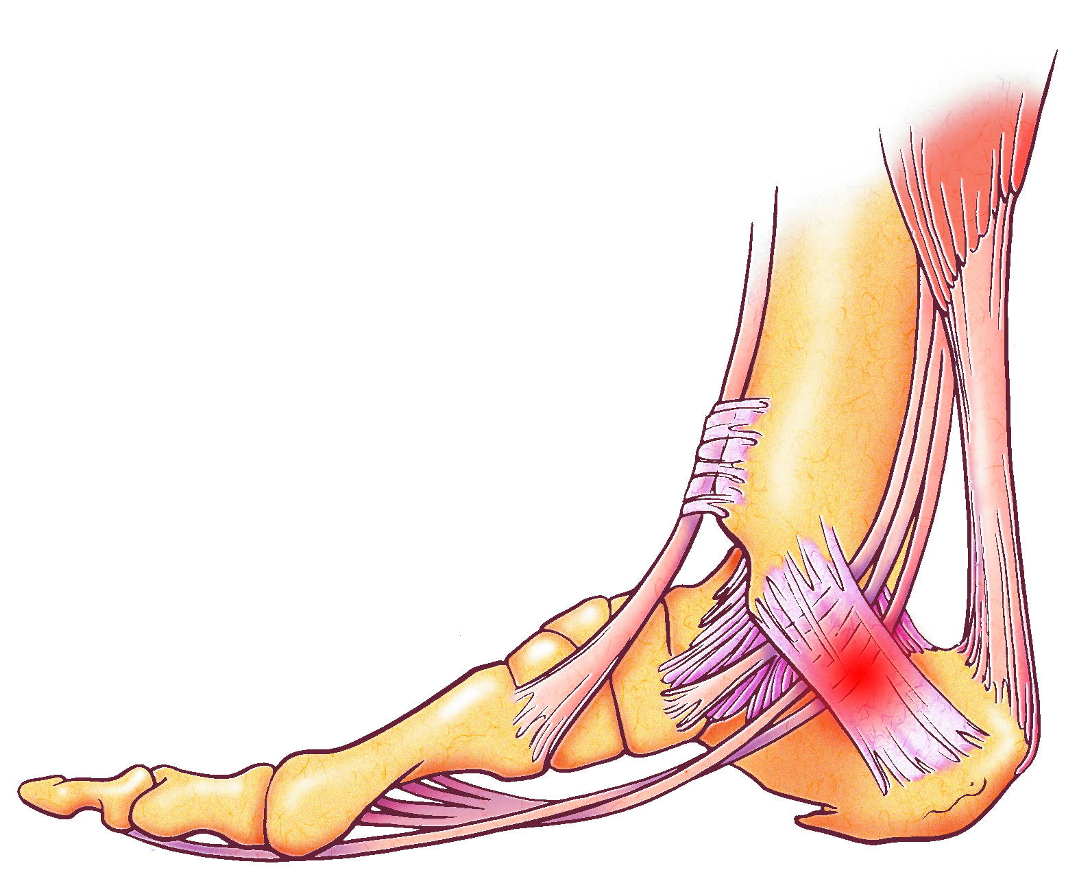 MILD STRAIN INJURY ILLUSTRATION