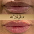Lip Fillers Wilmslow with Anti-wrinkle injections