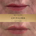 Lip Fillers Wilmslow with Anti-wrinkle injections