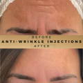 Frown Line Anti-Wrinkle Injections Wilmslow