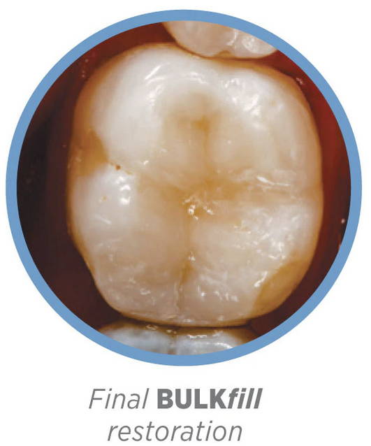 Final result of posterior tooth after Renamel BULKfill