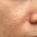 A close up of cheek and nose, showing the effects of clogged pores and oily skin, there are spots and the skin generally looks dull