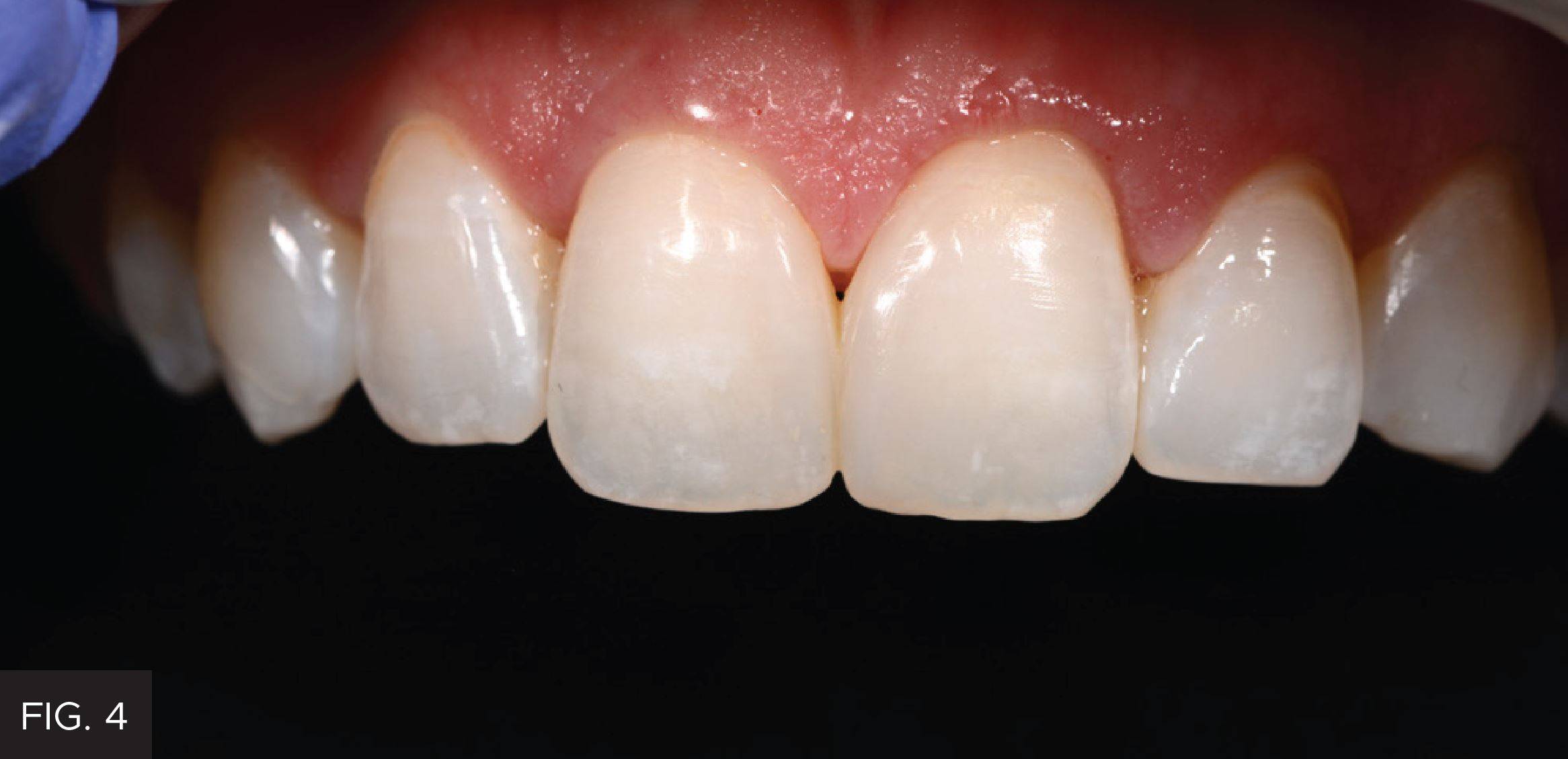 Gingival Sculpting With a Soft Tissue Diode Laser: Figure 4