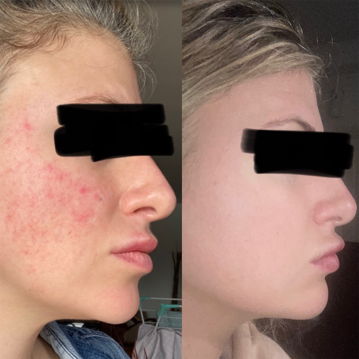 Can Rosacea be helped naturally