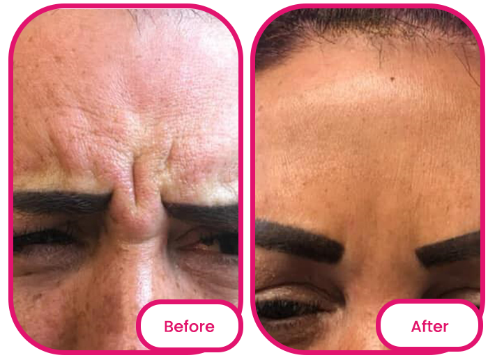 the forehead before and after taking the best collagen gummies singapore