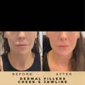 Jaw Fillers Wilmslow Before & After Dr Sknn
