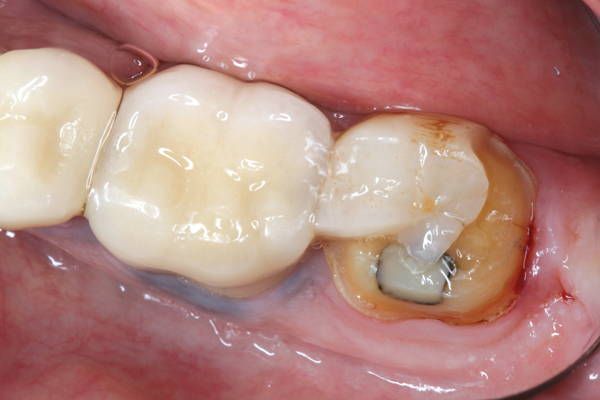 Fractured molar crown.