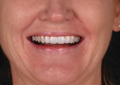 Smile showing the final result