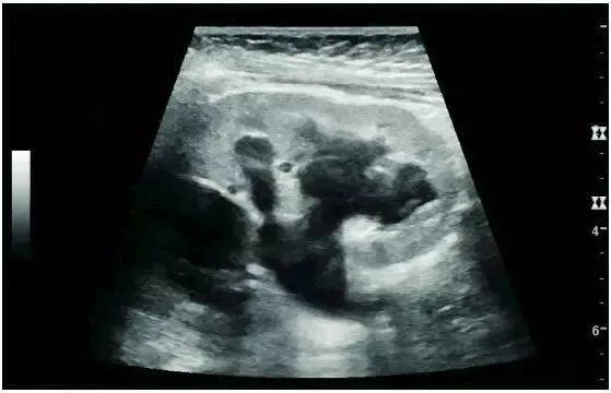 Hydronephrosis due to obstruction of the ureteropelvic junction in children — EagleView portable ultrasound.