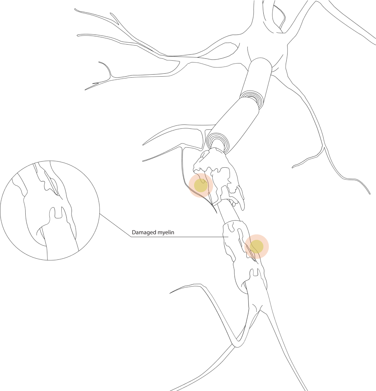 Damaged myelin illustration