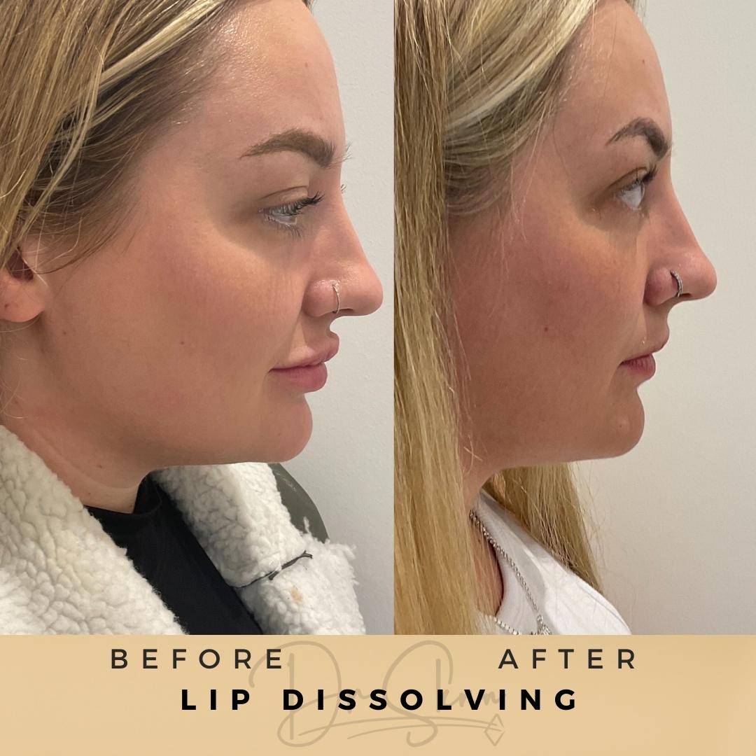 Lip Dissolving - Dr Sknn before and after