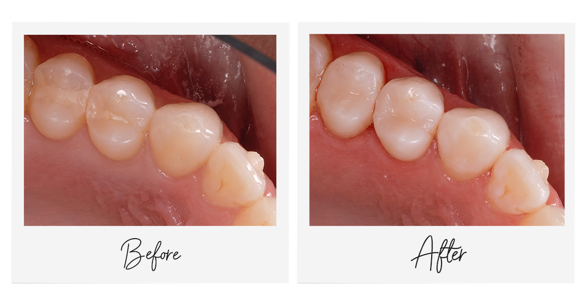 posterior teeth before and after restoration