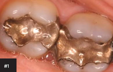 the patient presented with two large amalgams on #18 and #19 that required crowns