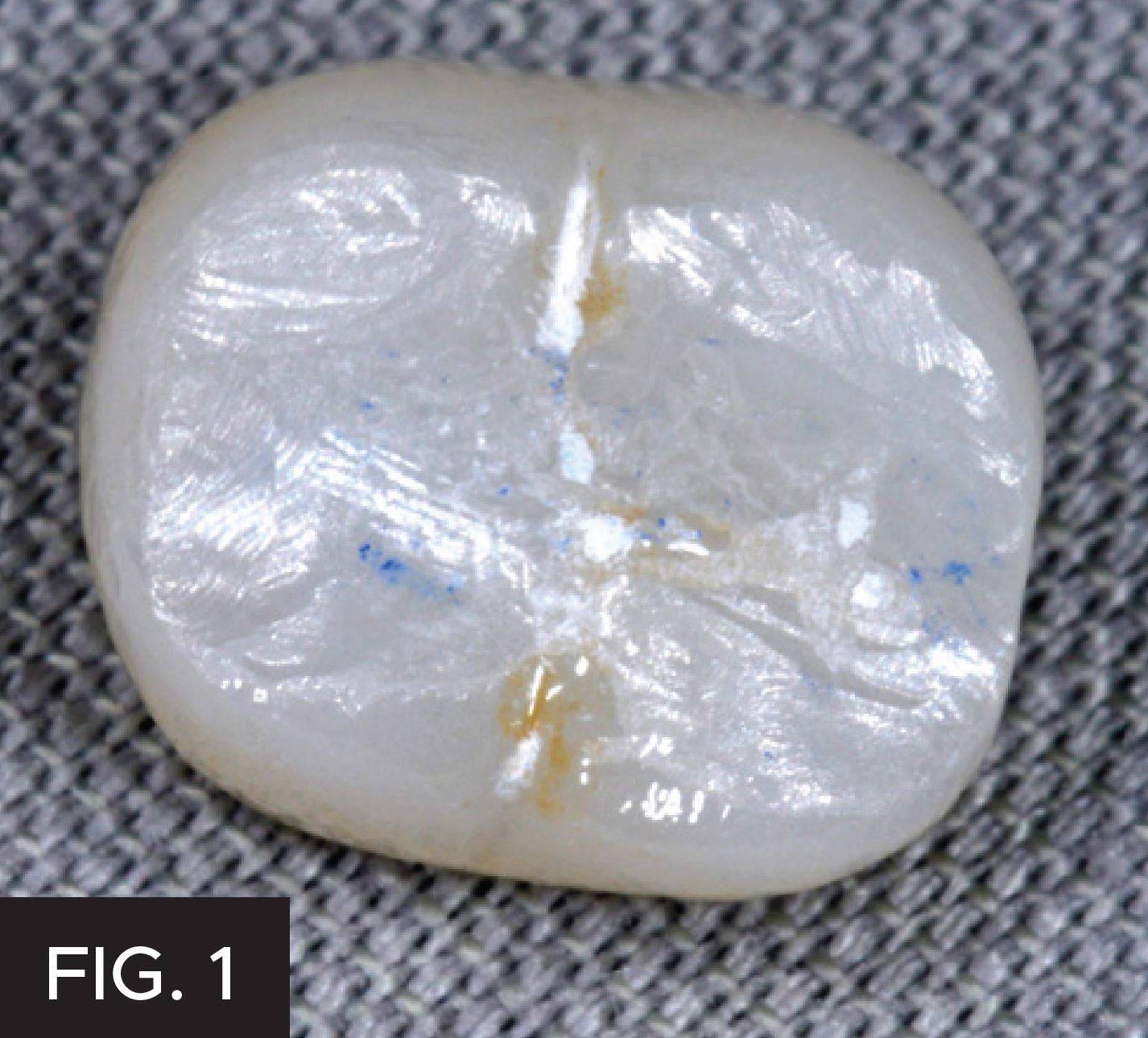 Zirconia crown after diamond bur adjustment.