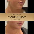 Chin Fillers Wilmslow Before & After Dr Sknn