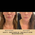 Anti-Wrinkle Injections Wilmslow Before & After Dr Sknn