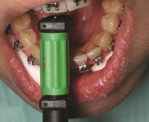 green handle strip reducing enamel on teeth with brackets