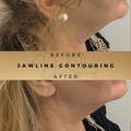 jaw line fillers wilmslow