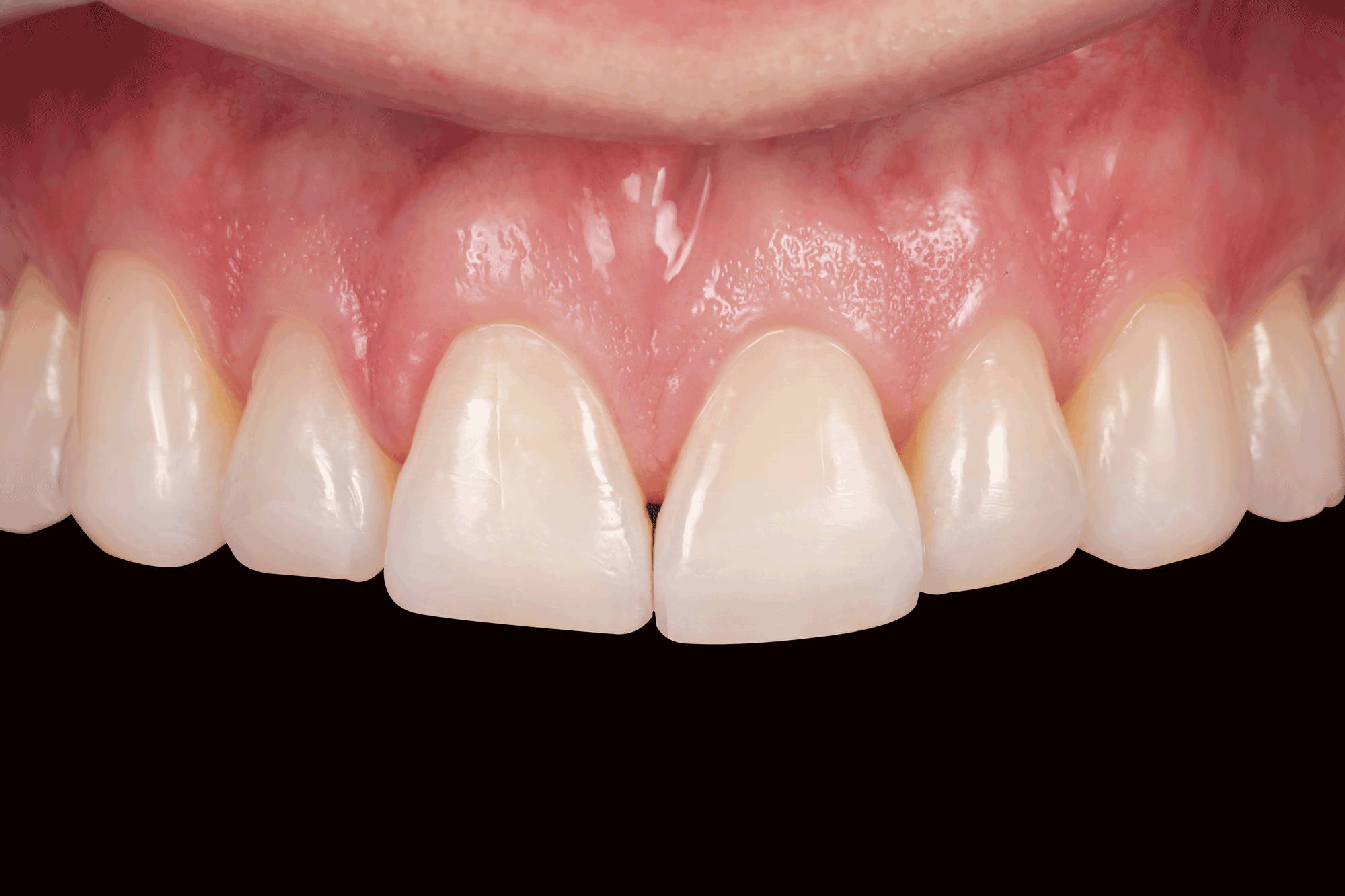 anterior teeth in black background