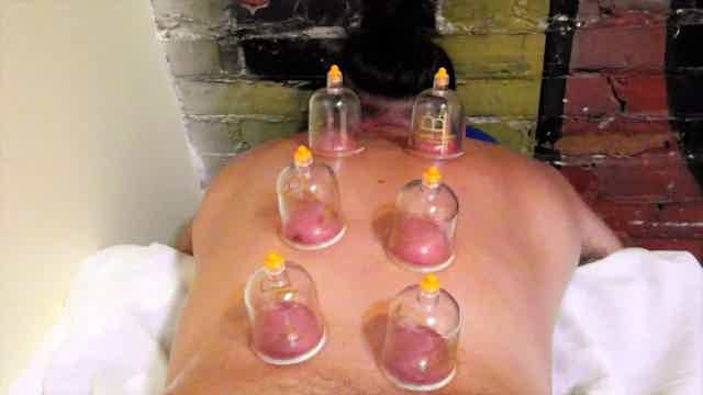 Cupping: Here's What You Need to Know