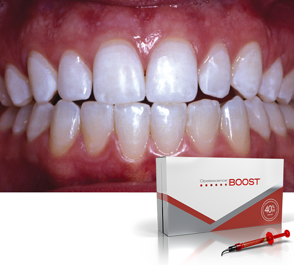 Opalescence Teeth: After whitening with carbamide peroxide whitening kit