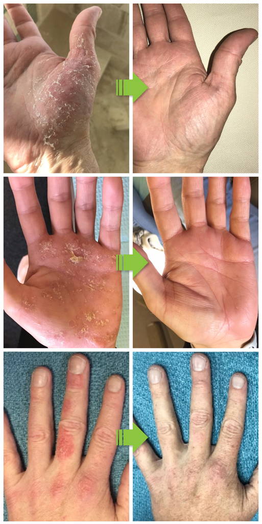 Before and Afters from using Eczema Flare Wipes. Customers saw awesome results from using it daily.