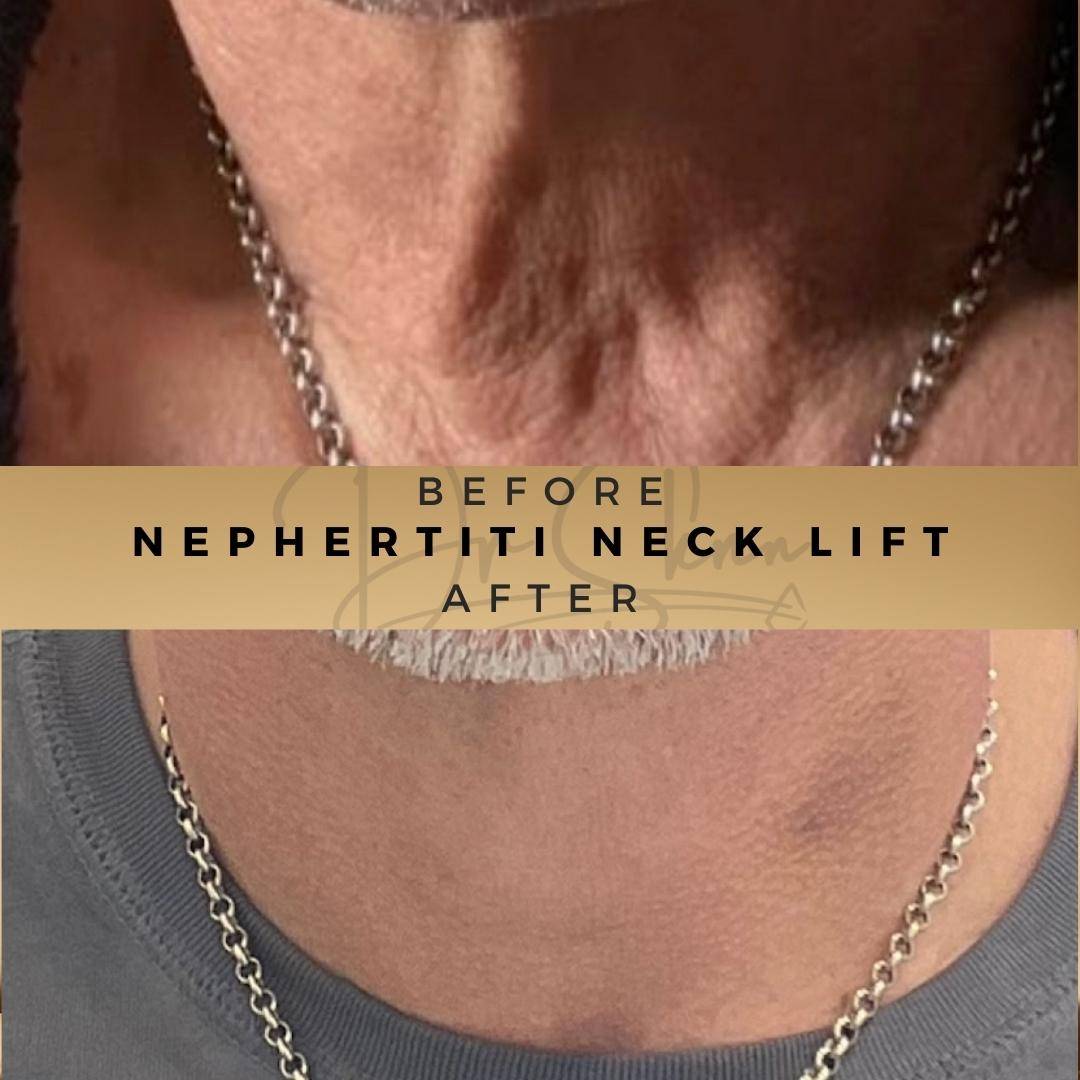 Nefertiti Neck Lift Wilmslow Before & After Dr Sknn