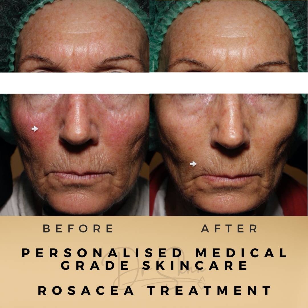 Rosacea Treatment Wilmslow Before & After Dr Sknn