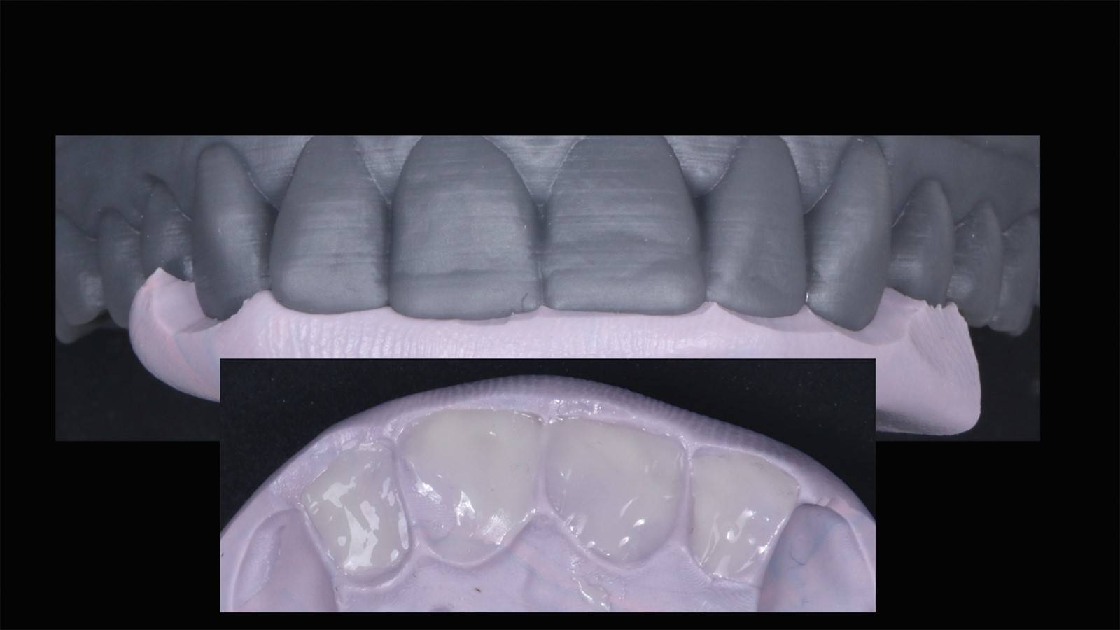 Digital model using to provide palatal stent