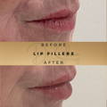 Lip Fillers Wilmslow with Anti-wrinkle injections