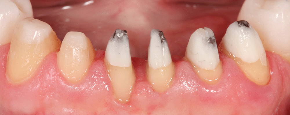 Deteriorated teeth with large spacing between them