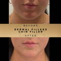Chin Fillers Wilmslow Before & After Dr Sknn