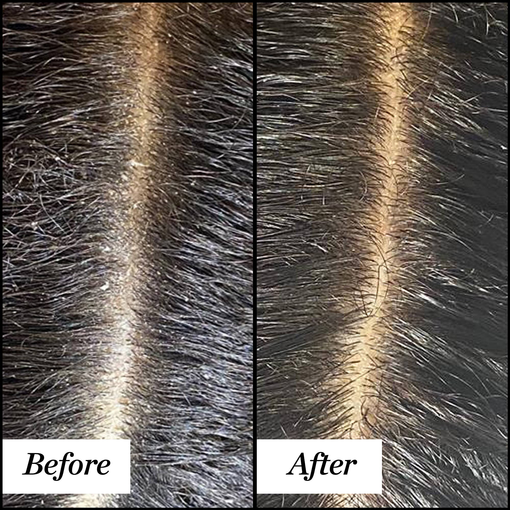 scalp flakiness dry scalp before and after