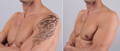 Simply You Med Spa Laser Tattoo Removal