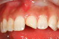 Anterior tooth missing a piece