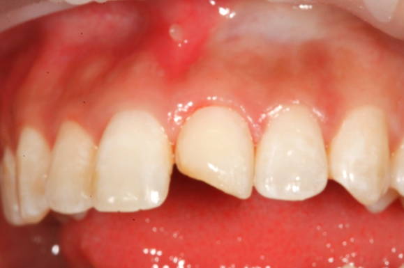 Anterior tooth missing a piece