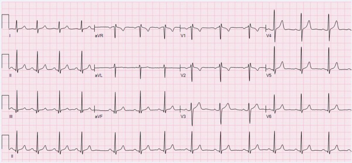 Arritmia sinusal, forma de onda de ECG de la arritmia sinusal