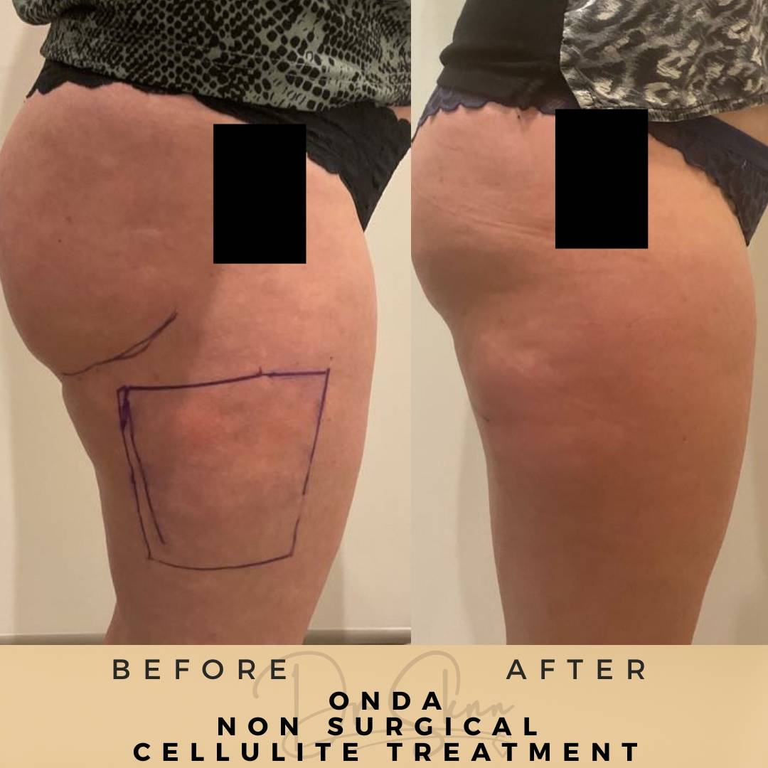 Cellulite Removal - Non-surgical - Dr Sknn before and after
