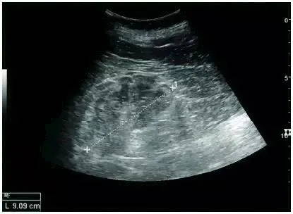 Chronic kidney disease due to glomerulonephritis scanned by EagleView portable ultrasound.