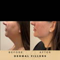 Jaw Fillers Wilmslow Before & After Dr Sknn