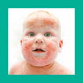 Baby with Eczema | The Milky Box